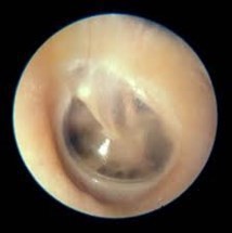 Normal eardrum